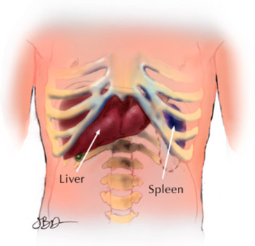 Symptoms and Causes of Enlarged Spleen (Splenomegaly)